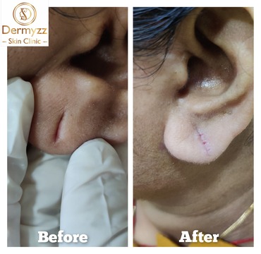 Earlobe Repair Treatment at Dermyzz Skin Clinic