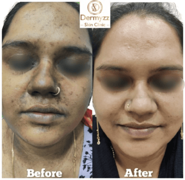 Pigmentation Treatment at Dermyzz Skin Clinic
