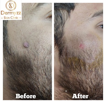 Wart Removal Treatment at Dermyzz Skin Clinic