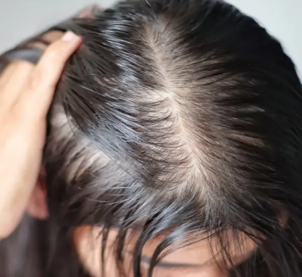 Best Treatment for Hairloss in Mumbai