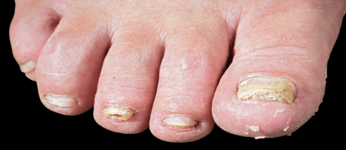 Best Nail Infection Treatment Clinic in Mumbai