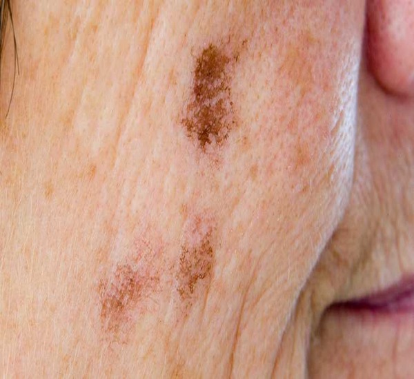 Old Age Skin Treatment in Mumbai