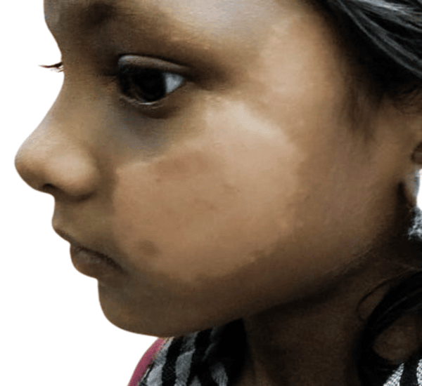 Best leprosy Treatment in Mumbai