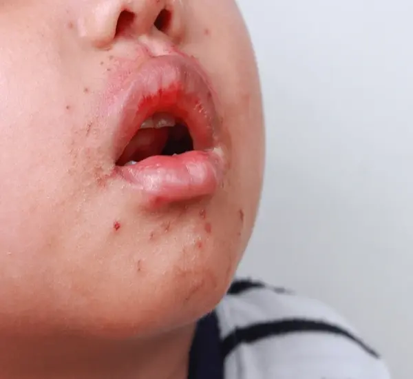 Best pediatric skin treament in Mumbai