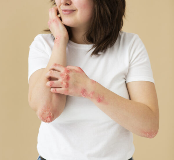Best Psoriasis Treatment Clinic in Mumbai