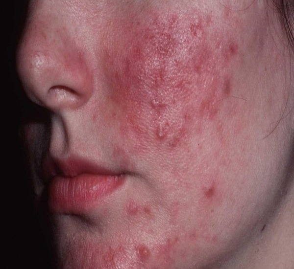 Best Treatment for rosacea Infection on Skin in Mumbai
