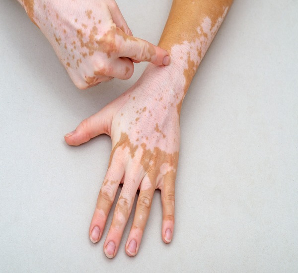 Best Vitiligo Treatment Center in Mumbai