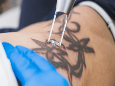 Reliable Tattoo removal in Dermyzz Skin Clinic Andheri Mumbai