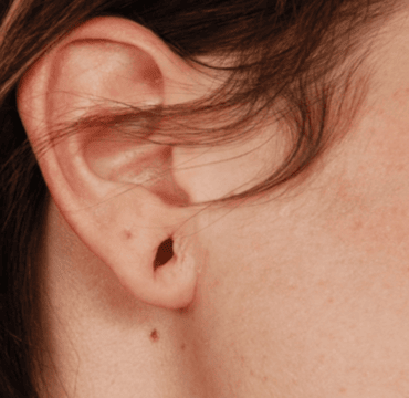 Earlobe repair surgery at Dermyzz Skin Clinic